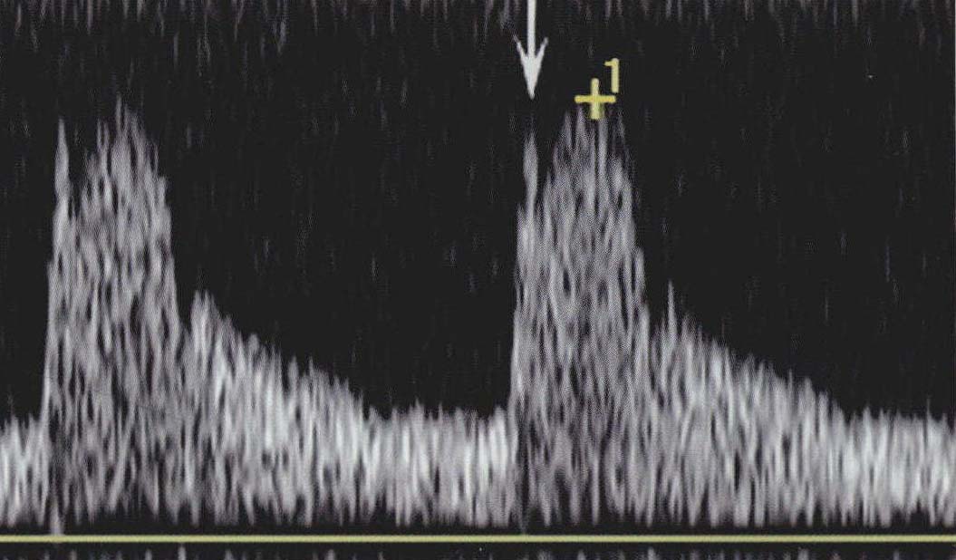 肾动脉的正常超声表现与正常值